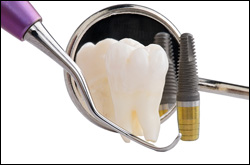 Dental Implants Grand Rapids MI